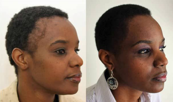 Afro Hair Transplant