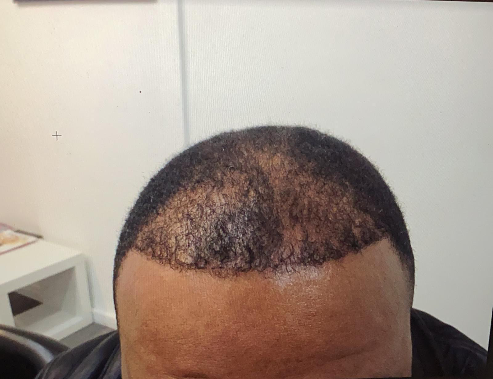 Afro Hair Transplant Example