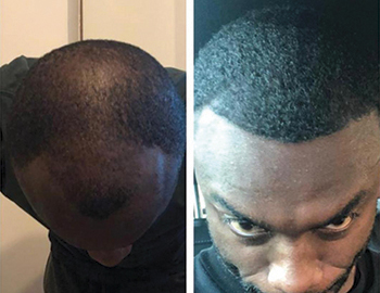 Afro Hair Transplant Example