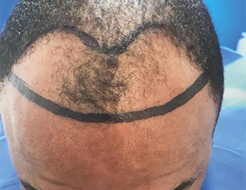 Afro Hair Transplant Example