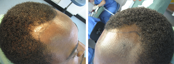 Afro Hair Transplant