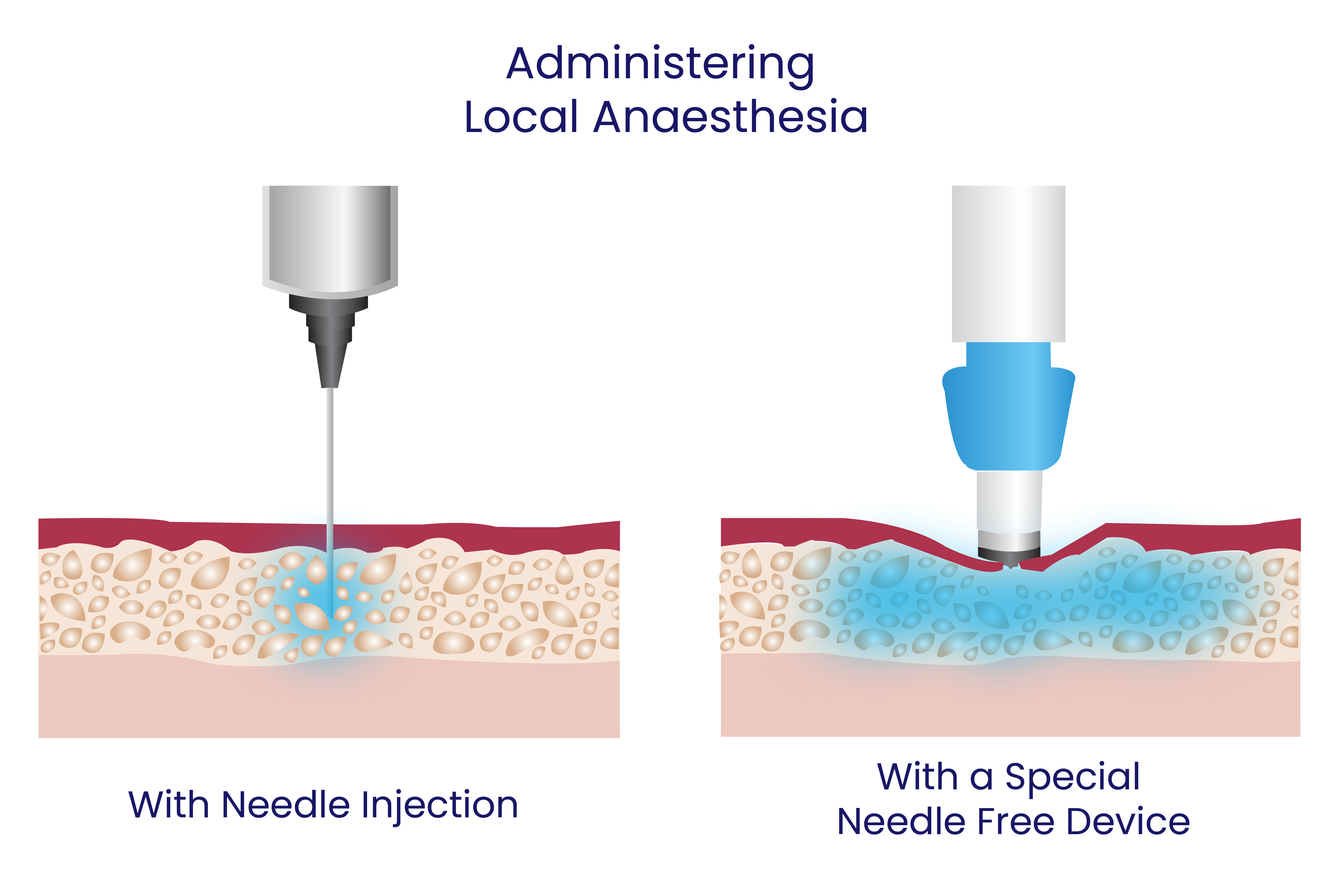 Needle-Free Diagram