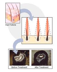 Photo Diode Therapy Process