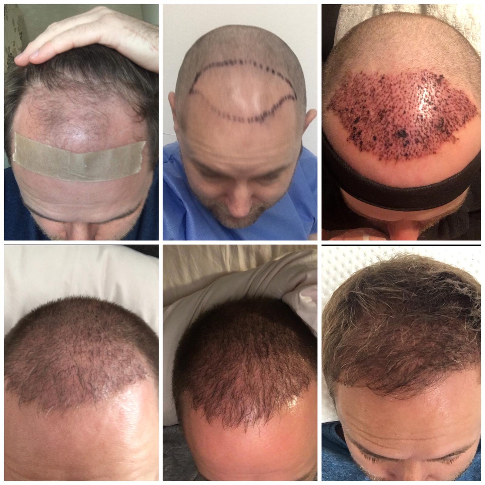 Un-Shaven Hair Transplant Technique | Hair Growth Centre